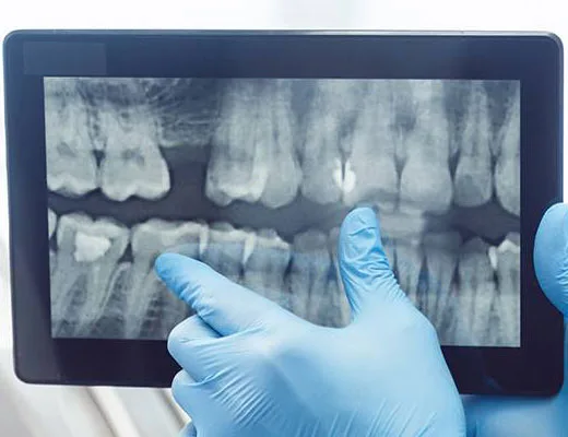 Bone Grafting